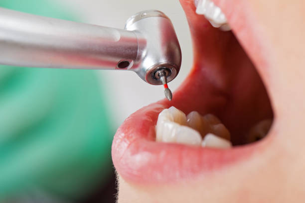 Best Emergency Root Canal Treatment in Mcfarland, WI